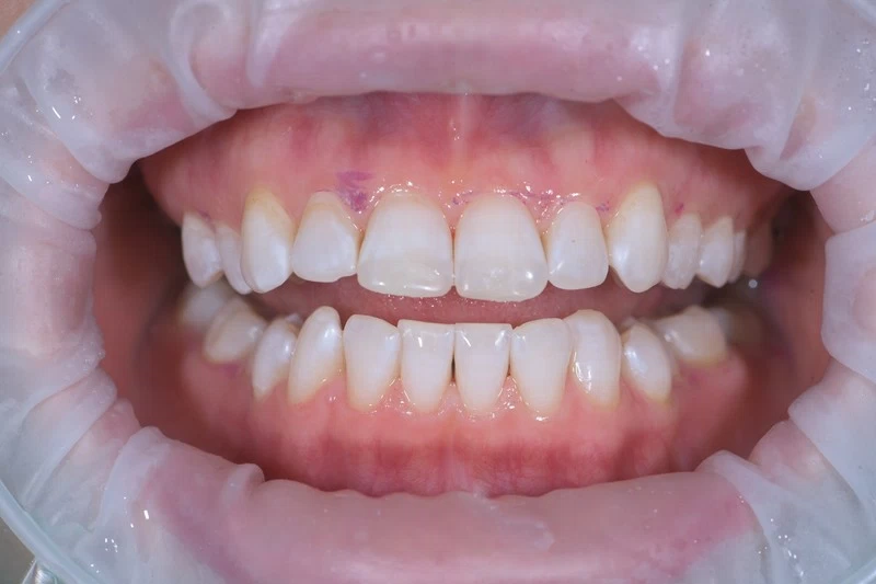 Индикация налета и чистка зубов