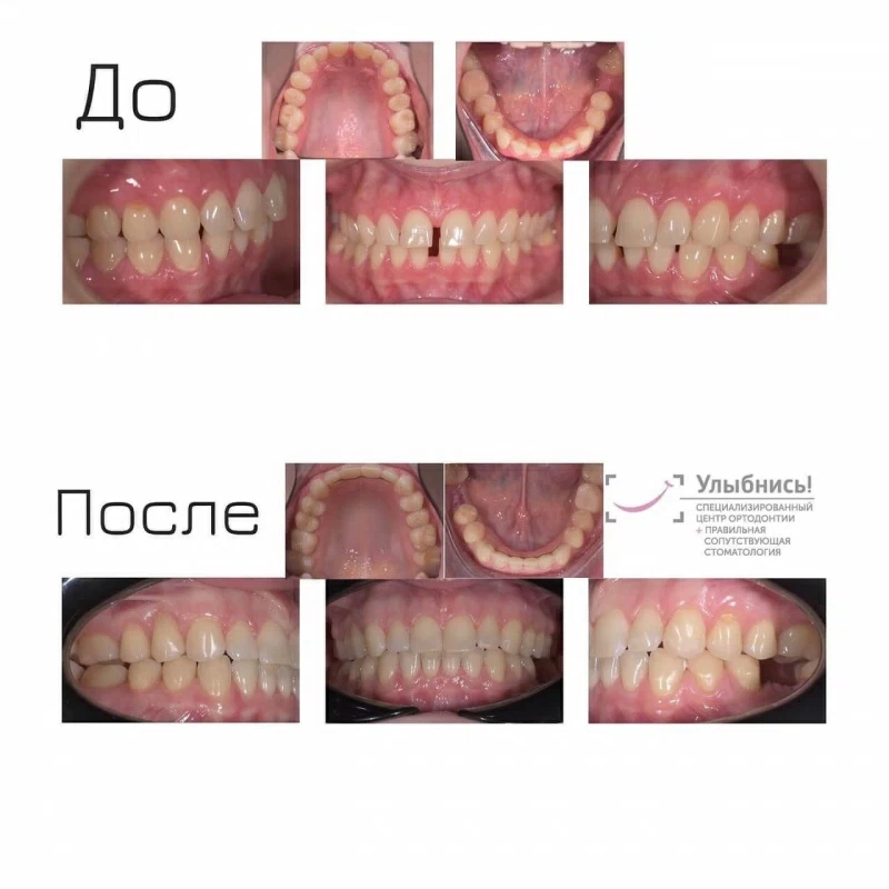 Лечение на элайнерах Лечение на элайнерах