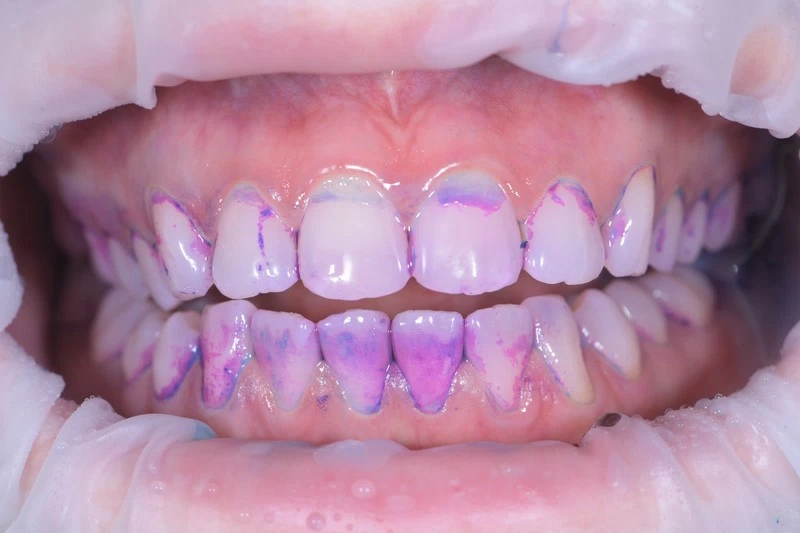 Чистка по швейцарскому протоколу GBT