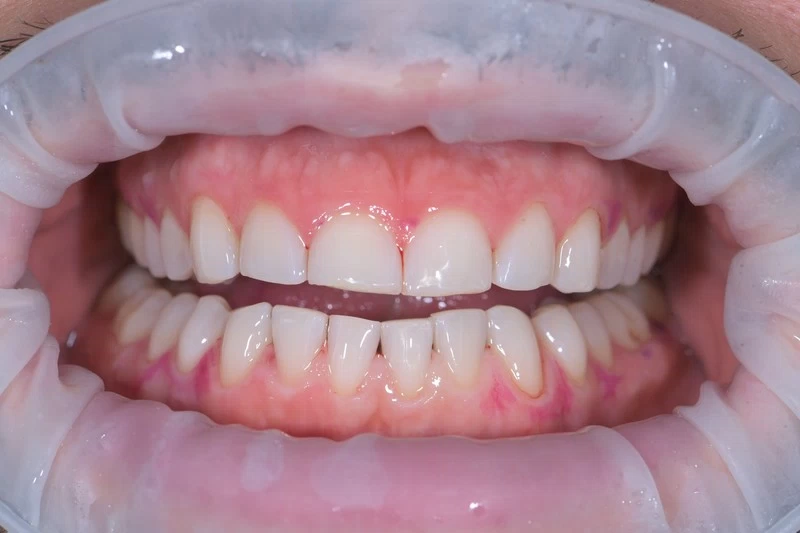 Чистка зубов по протоколу GBT