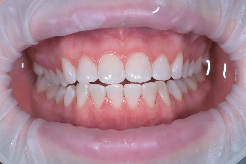 Чистка по швейцарскому протоколу GBT