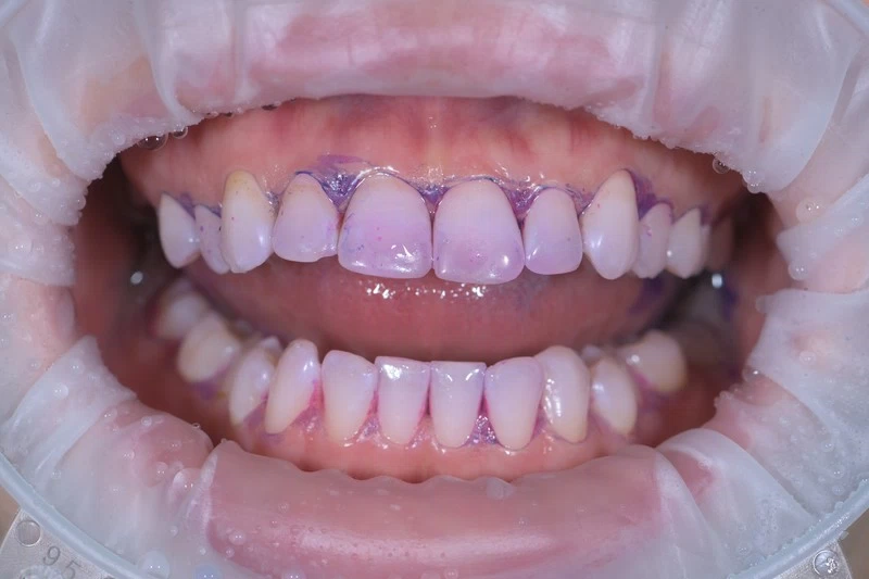 Индикация налета и чистка зубов