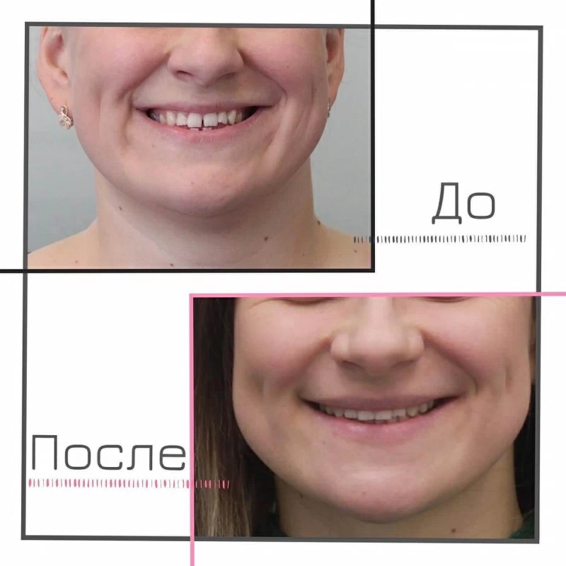 Ортогнатическая хирургия Ортогнатическая хирургия