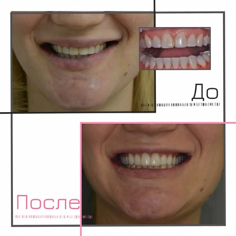 Виниры Виниры