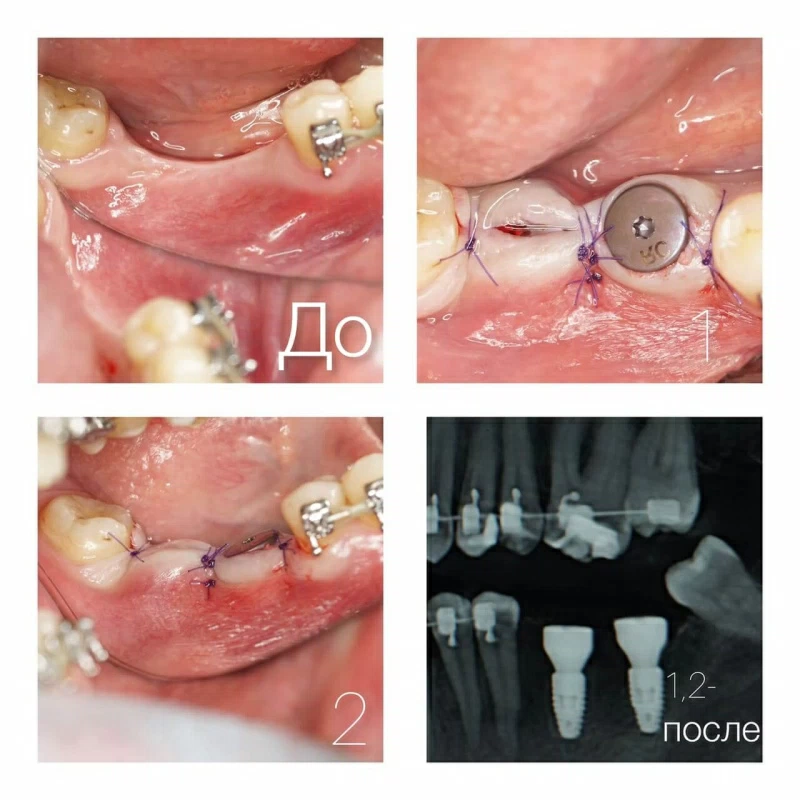 Имплантация Имплантация