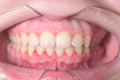 Скученность нижних зубов Фото До и После