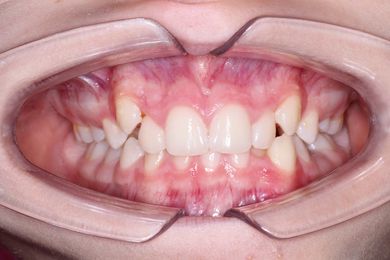 Капы для выравнивания зубов Flexiligner Фото До и После
