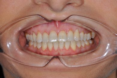 Скученность нижних зубов Фото До и После