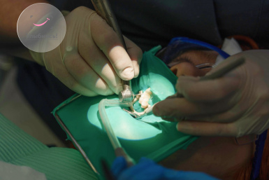 Пломбирование каналов зубов Пломбирование каналов зубов