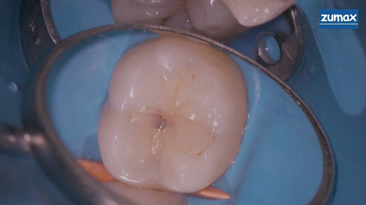 Лечение зубов под седацией взрослым Фото До и После