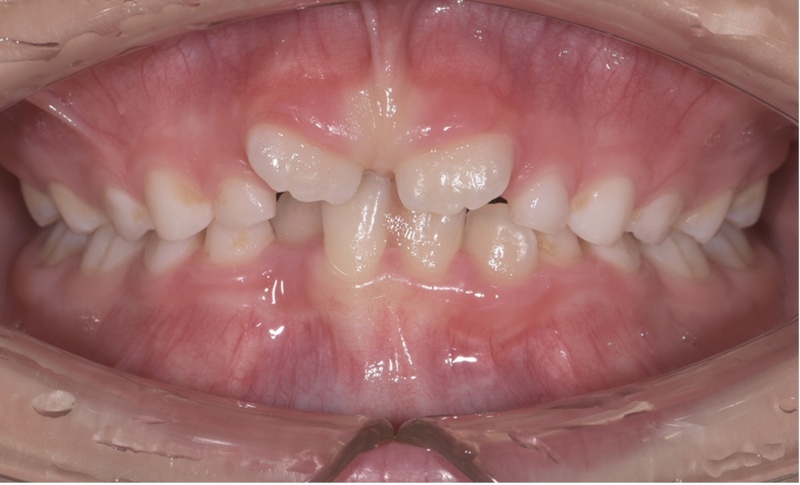 Ортодонтические аппараты Фото До и После