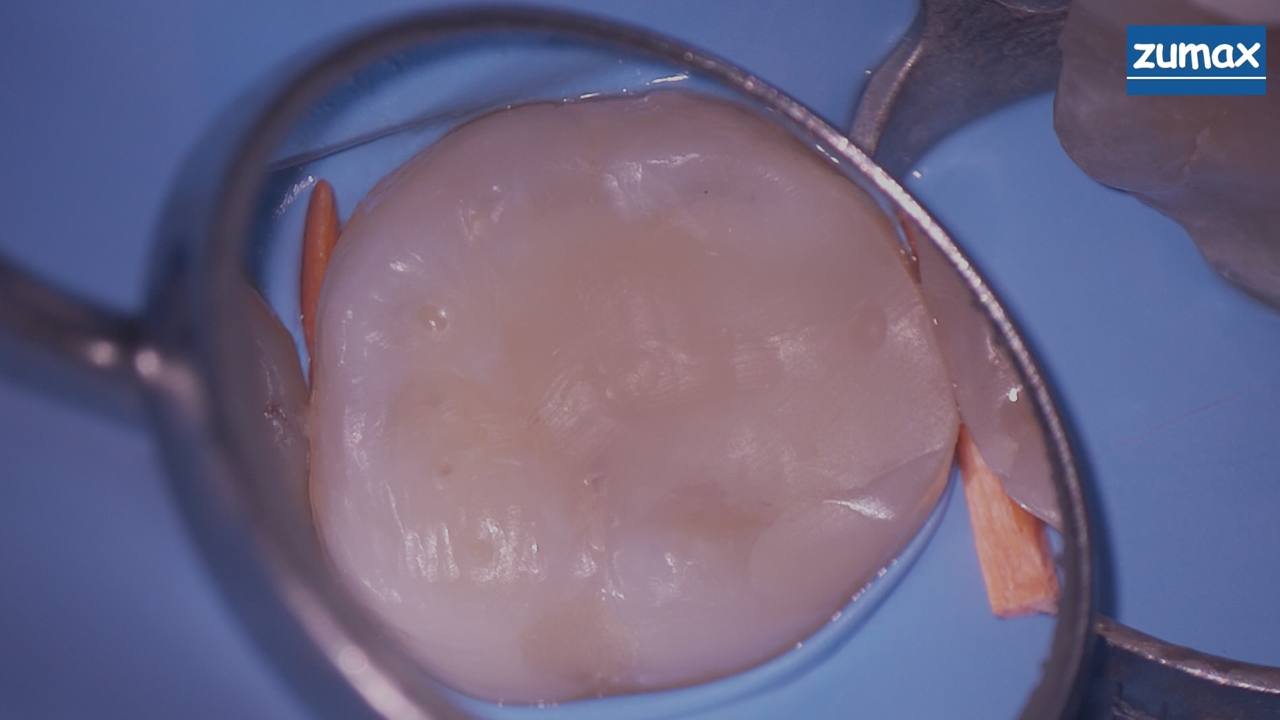 Лечение зубов под микроскопом Фото До и После