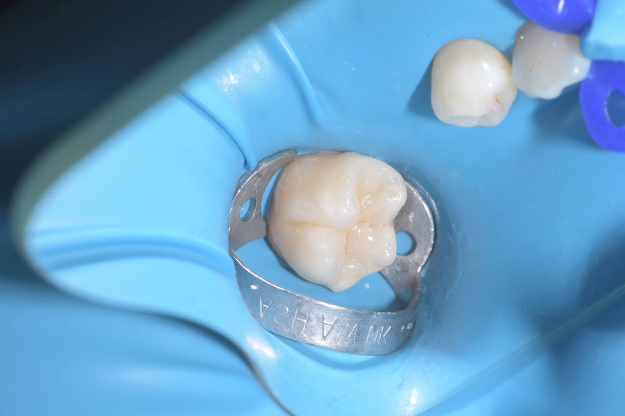 Лечение зубов под седацией взрослым Фото До и После