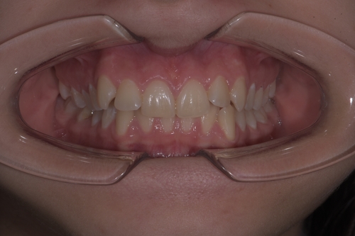Скученность зубов Фото До и После
