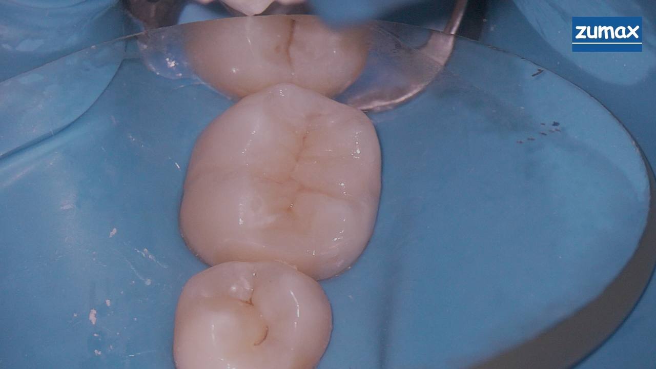 Лечение зубов под наркозом взрослым Фото До и После